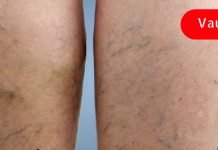 მამაჩემმა სისხლძარღვები ყოველგვარი ოპერაციის გარეშე მოირჩინა! აი რა გააკეთა მან!