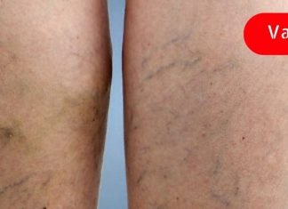 მამაჩემმა სისხლძარღვები ყოველგვარი ოპერაციის გარეშე მოირჩინა! აი რა გააკეთა მან!