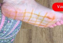 წაისვით ქუსლებზე იოდი ამ დაავადებების სამკურნალოდ! ეფექტურია!