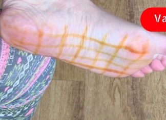 წაისვით ქუსლებზე იოდი ამ დაავადებების სამკურნალოდ! ეფექტურია!