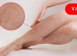 ვარიკოზული ვენები ფეხებზე: რა იწვევს მას და როგორ ვუმკურნალოთ სახლის პირობებში?