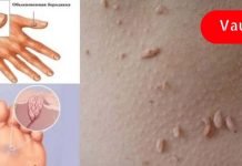 ამ მეთოდებით ჩვენ სწრაფად, იაფად და ეფექტურად ვაშორებთ მეჭეჭებს, მუქ ლაქებს, შავ წერტილებს და პაპილომებს!