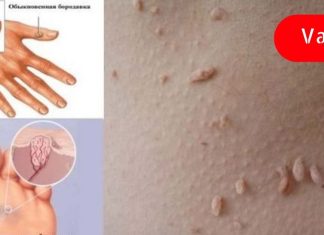 ამ მეთოდებით ჩვენ სწრაფად, იაფად და ეფექტურად ვაშორებთ მეჭეჭებს, მუქ ლაქებს, შავ წერტილებს და პაპილომებს!