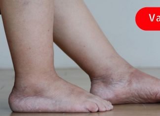 საუკეთესო საშუალება ორგანიზმში სითხის შეკავების, შეშუპებისა და ჭარბი წონის წინააღმდეგ!