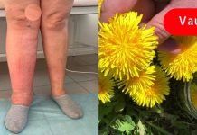 კიდურების შეშუპება შეიძლება გამოწვეული იყოს წყლის შეკავებით! ამ მეთოდებით ორგანიზმს დაეხმარებით წყლის გამოდევნაში!