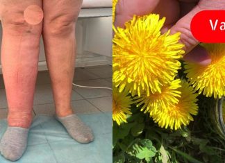 კიდურების შეშუპება შეიძლება გამოწვეული იყოს წყლის შეკავებით! ამ მეთოდებით ორგანიზმს დაეხმარებით წყლის გამოდევნაში!