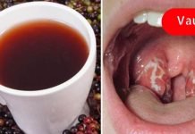 იმკურნალეთ ყელის სტრეპტოკოკზე ბუნებრივი მეთოდებით! ის დაგიამებთ ტკივილს!