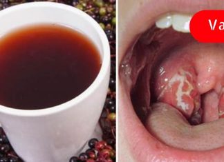 იმკურნალეთ ყელის სტრეპტოკოკზე ბუნებრივი მეთოდებით! ის დაგიამებთ ტკივილს!