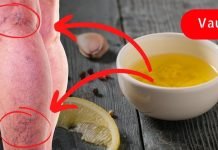 გამოიყენეთ ნივრის ზეთი ვარიკოზული ვენების ანთების შესამცირებლად! მისი წყალობით ჩემმა დედამთილმა განიკურნა გაღიზიანებული ვენები!