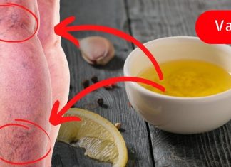 გამოიყენეთ ნივრის ზეთი ვარიკოზული ვენების ანთების შესამცირებლად! მისი წყალობით ჩემმა დედამთილმა განიკურნა გაღიზიანებული ვენები!