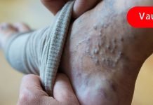 გამოიყენეთ საშინაო საშუალებები ვარიკოზული ვენებისთვის.. დაივიწყეთ აბები!