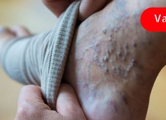 გამოიყენეთ საშინაო საშუალებები ვარიკოზული ვენებისთვის.. დაივიწყეთ აბები!