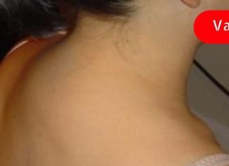 გამოიყენეთ ეს რეცეპტი მარილების სამკურნალოდ. ძალიან ეფექტურია!