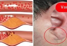 სასწრაფოდ! ეს ნიშნები გვაფრთხილებს არტერიების ჩაკეტვაზე! აუცილებლად გაეცანი მათ!