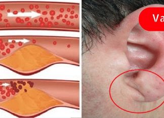 სასწრაფოდ! ეს ნიშნები გვაფრთხილებს არტერიების ჩაკეტვაზე! აუცილებლად გაეცანი მათ!