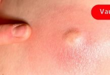 გამოიყენეთ ეს ხელნაკეთი საშუალება ლიპომების შესამცირებლად! მისი ეფექტიურობა დადასტურებულია!