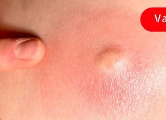 გამოიყენეთ ეს ხელნაკეთი საშუალება ლიპომების შესამცირებლად! მისი ეფექტიურობა დადასტურებულია!