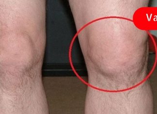 თუ მუხლში სითხე ჩაგიდგათ გამოიყენეთ ეს ბუნებრივი დამარტივი გზა მის სწრაფად მოსაცილებად! ეს მეთოდი ბევრმა გამოსცადა!