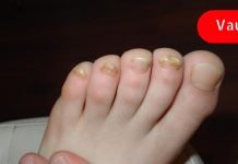 რა არის ფეხის გასქელებული ფრჩხილების მიზეზი? ამის ცოდნა ბევრს გამოადგება!