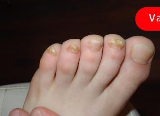 რა არის ფეხის გასქელებული ფრჩხილების მიზეზი? ამის ცოდნა ბევრს გამოადგება!