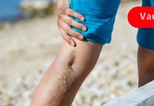 თუ გაწუხებს ვარიკოზული ვენები ან ბუასილი, სცადე ეს ეთოდი, ერთ კვირაში შვებას იგრძნობ!