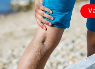 თუ გაწუხებს ვარიკოზული ვენები ან ბუასილი, სცადე ეს ეთოდი, ერთ კვირაში შვებას იგრძნობ!