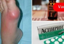 თუ ფეხის თითზე ბურსიტი გამოგივიდა, გირჩევ ეს მეთოდი გამოიყენო! მე ამან მიშველა!