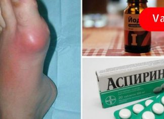 თუ ფეხის თითზე ბურსიტი გამოგივიდა, გირჩევ ეს მეთოდი გამოიყენო! მე ამან მიშველა!