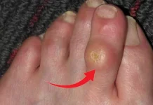 მოიშორეთ კოჟრები და მაზოლები ამ მეთოდებით! პირადად მე მე-5 მეთოდი ძალიან დამეხარა!