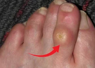 მოიშორეთ კოჟრები და მაზოლები ამ მეთოდებით! პირადად მე მე-5 მეთოდი ძალიან დამეხარა!