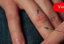 გამოიყენეთ წყალბადის ზეჟანგი მეჭეჭებისა და პაპილომების მოსაცილებლად! ეფექტურია!