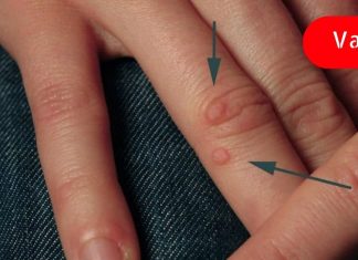 გამოიყენეთ წყალბადის ზეჟანგი მეჭეჭებისა და პაპილომების მოსაცილებლად! ეფექტურია!