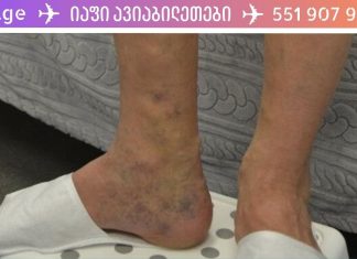 ეს ბალზამი საუკეთესო საშუალებაა სისხლძარღვთა ქსელის მოსაშორებლად და კანის სილამაზის აღდგენისთვის!