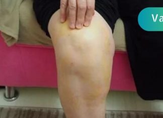 თუ მუხლში სითხე ჩაგიდგათ, მაშინ ეს სტატია თქვენთვისაა!