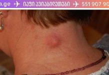 მოიშორეთ ლიპომა (ცხიმოვანი ქსოვილი) ხალხური მეთოდებით! ეს მეთოდი საკუთარ თავზე გამოვცადე!