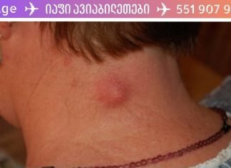 მოიშორეთ ლიპომა (ცხიმოვანი ქსოვილი) ხალხური მეთოდებით! ეს მეთოდი საკუთარ თავზე გამოვცადე!