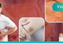 ღვიძლის ციროზის სიმპტომები: ღვიძლის დაავადების კანის 7 გამაფრთხილებელი ნიშანი, რომელიც არ უნდა უგულებელყოთ