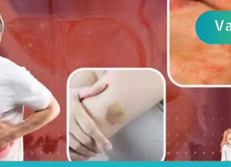 ღვიძლის ციროზის სიმპტომები: ღვიძლის დაავადების კანის 7 გამაფრთხილებელი ნიშანი, რომელიც არ უნდა უგულებელყოთ