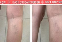 ფეხებზე არსებული სისხლძარღვები ძალიან შეუხედავი და მტკივნეულია, ამიტომ გამოიყენე ეს ხალხური საშუალებები და დაისვენე!