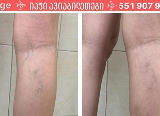 ფეხებზე არსებული სისხლძარღვები ძალიან შეუხედავი და მტკივნეულია, ამიტომ გამოიყენე ეს ხალხური საშუალებები და დაისვენე!